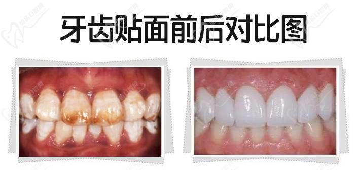 我做牙齒貼面5年后感受，看瓷貼面效果圖