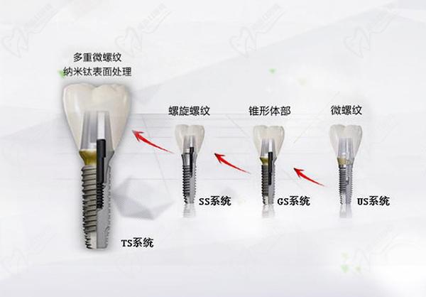 韓國(guó)OSSTEM奧齒泰種植牙