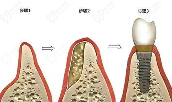 種植牙骨粉和骨膜在什么情況下使用