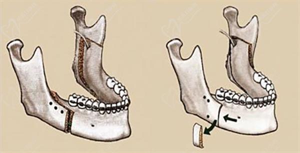 成都正頜手術費用一般是多少錢