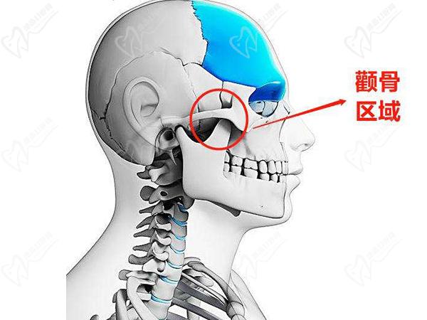 穿顴種植的利弊