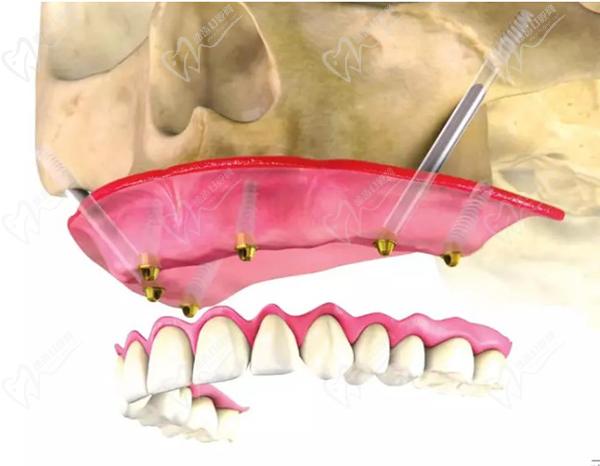 即速戴·速導(dǎo)種植技術(shù)技術(shù)優(yōu)勢
