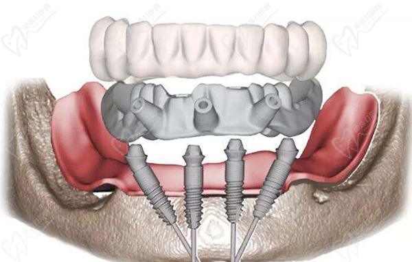 西安滿口種植牙allon4/allon6即刻負重種植價格