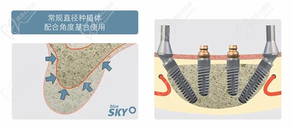 德國sky種植體優(yōu)點