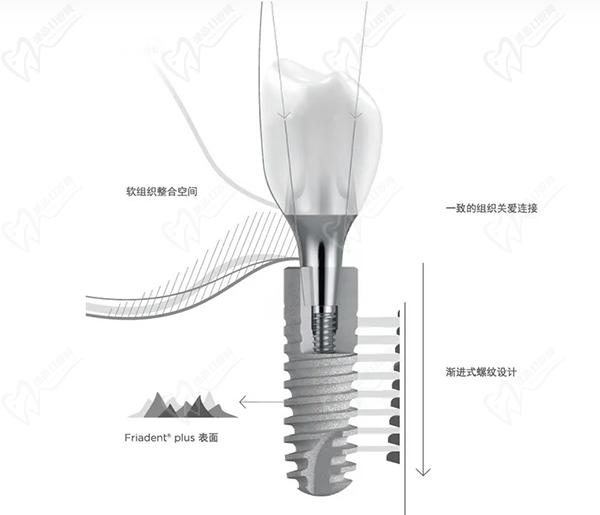 德國費亞丹種植牙好嗎