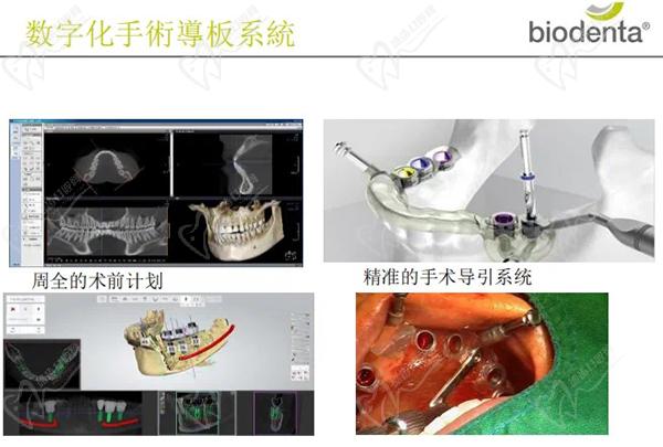 百丹特種植體怎么樣