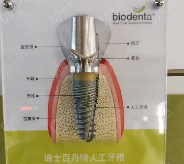 百丹特種植體價格