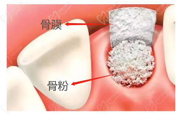 種植牙植骨需要多長(zhǎng)時(shí)間與骨結(jié)合