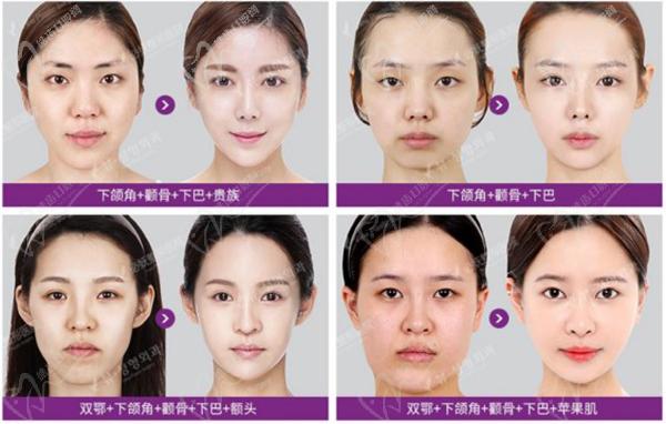 韓國必嫵整形醫(yī)院輪廓整形價(jià)格