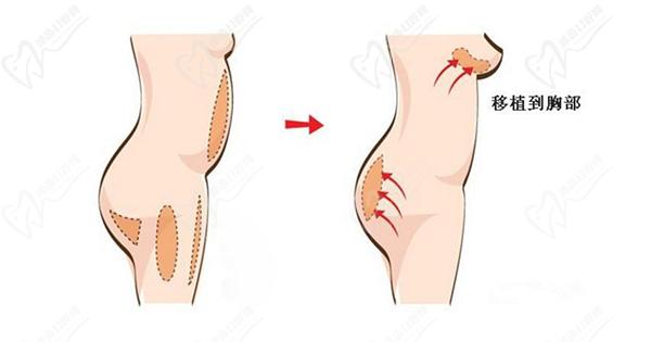 深圳劉學(xué)軍 醫(yī)生脂肪填充怎么樣