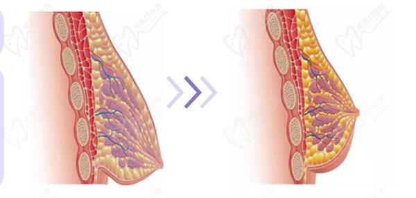 深圳南雅整形醫(yī)院做提胸手術怎么樣？