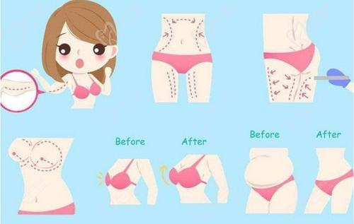 合肥壹加壹孟松抽脂怎么樣