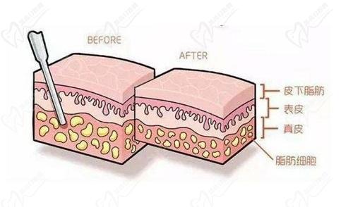 合肥壹加壹孟松5a規(guī)范腰腹吸脂優(yōu)勢(shì)超多