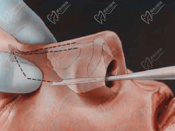 重慶劉巍鼻整形
