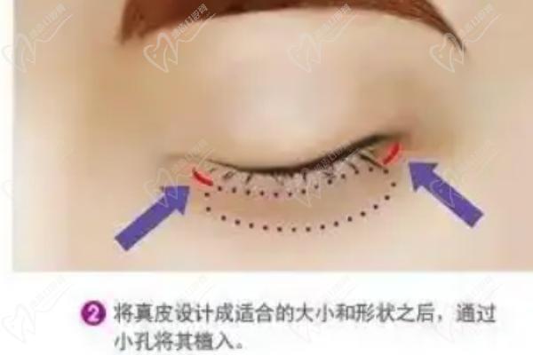 北京薛紅宇醫(yī)生眼袋項(xiàng)目簡(jiǎn)介