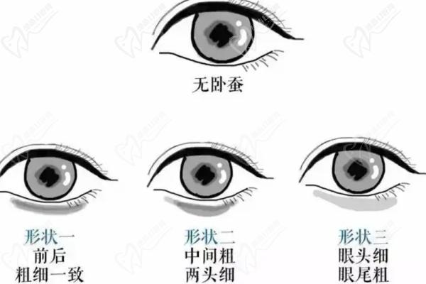 北京薛紅宇醫(yī)生做眼袋術(shù)后成效