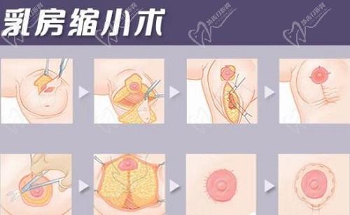 重慶劉正茂醫(yī)生縮胸怎么樣？