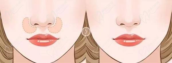 上海葉麗萍醫(yī)生做鼻基底手術(shù)嗎？