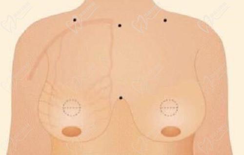 重慶劉正茂醫(yī)生縮胸怎么樣?想問(wèn)劉正茂醫(yī)生和曹勇哪個(gè)厲害啊